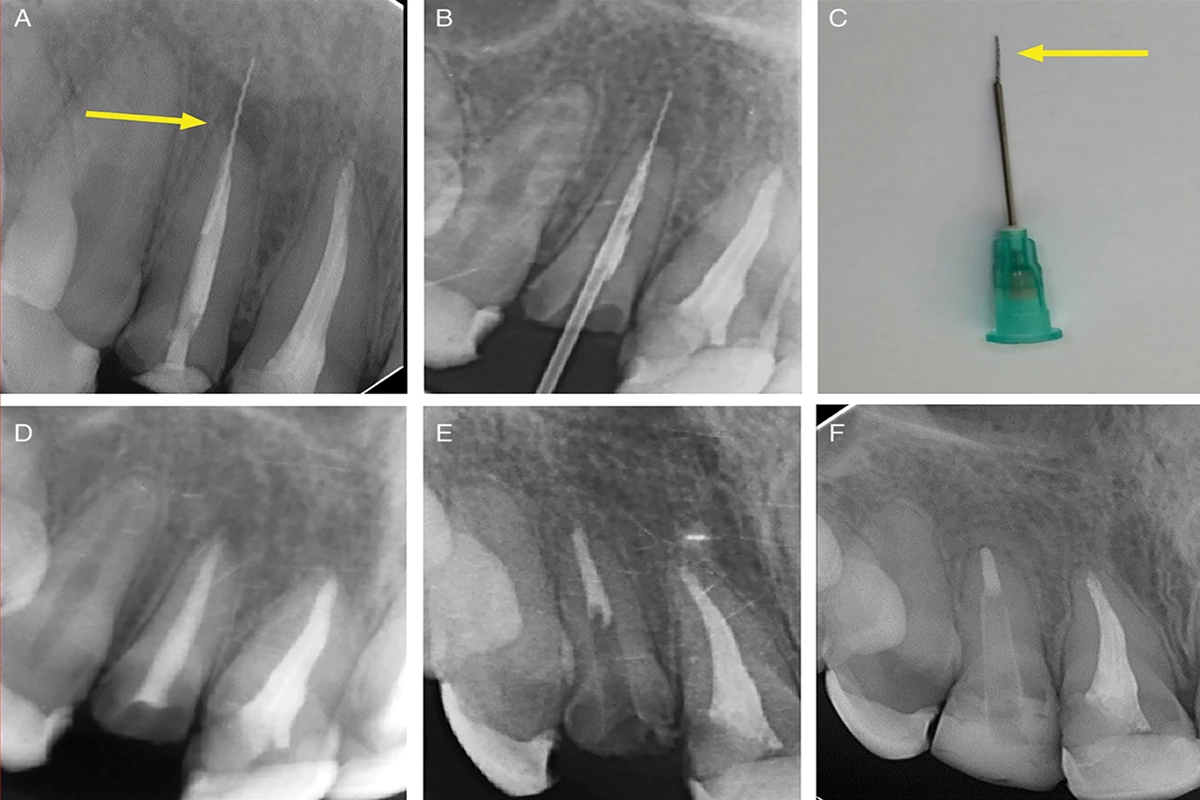 درمان شکستن فایل دندانپزشکی | سورنا تجهیزات دندانپزشکی