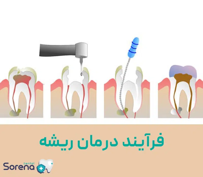 مراحل پست و روکش دندان