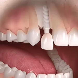 پست دندانپزشکی چیست