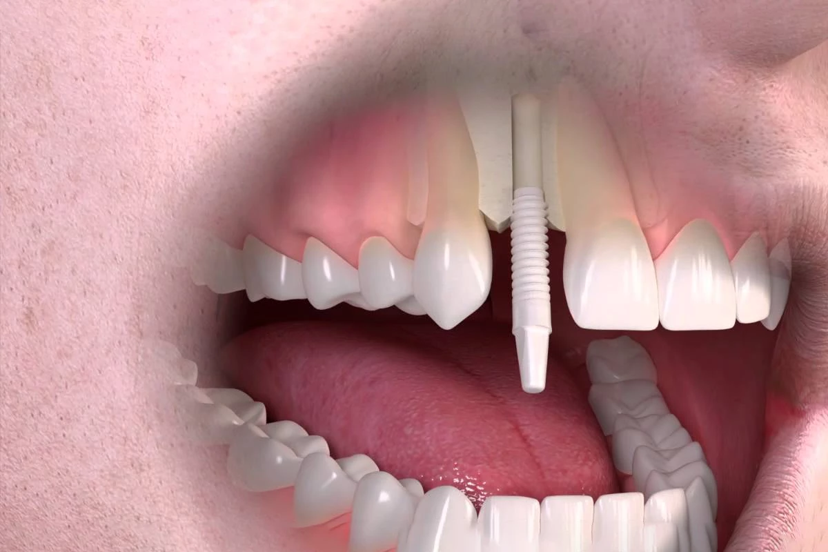 پست دندان چیست