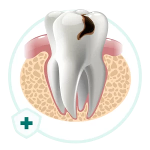 خرید تشخیص پوسیدگی دندانپزشکی