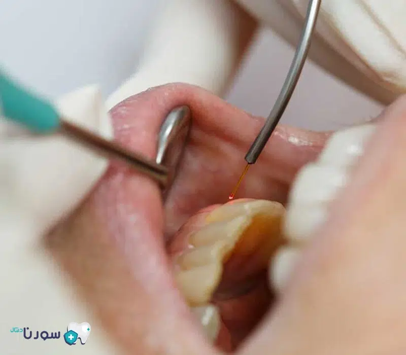 مزایای جراحی بازسازی انساج لثه