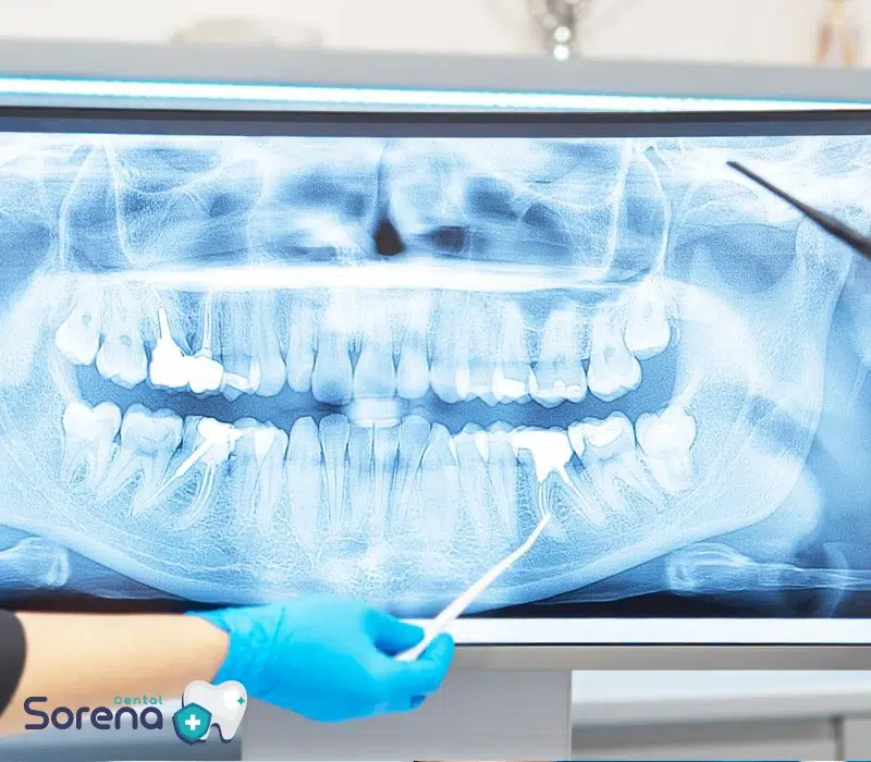 انواع رادیوگرافی های دندان پزشکی
