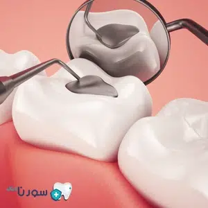 آمالگام چیست؟