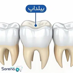 ترمیم بیلداپ چیست؟