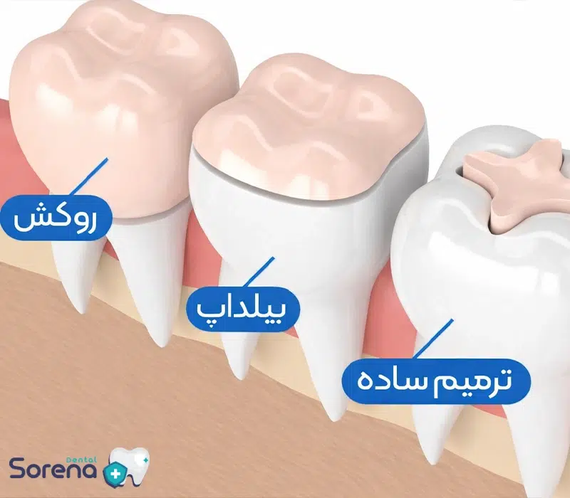 تفاوت بیلداپ و روکش دندان