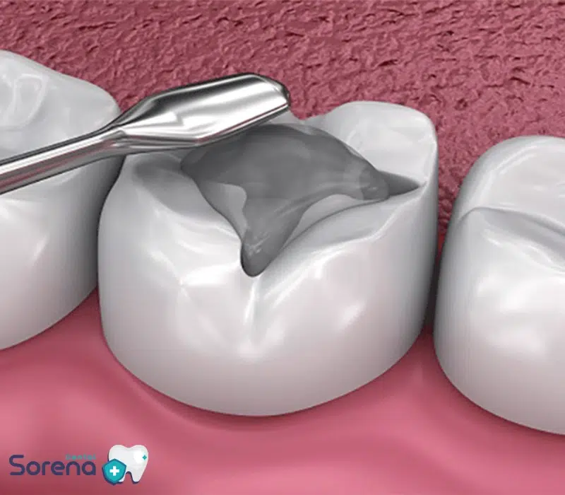 ترمیم بیلداپ دندان چیست