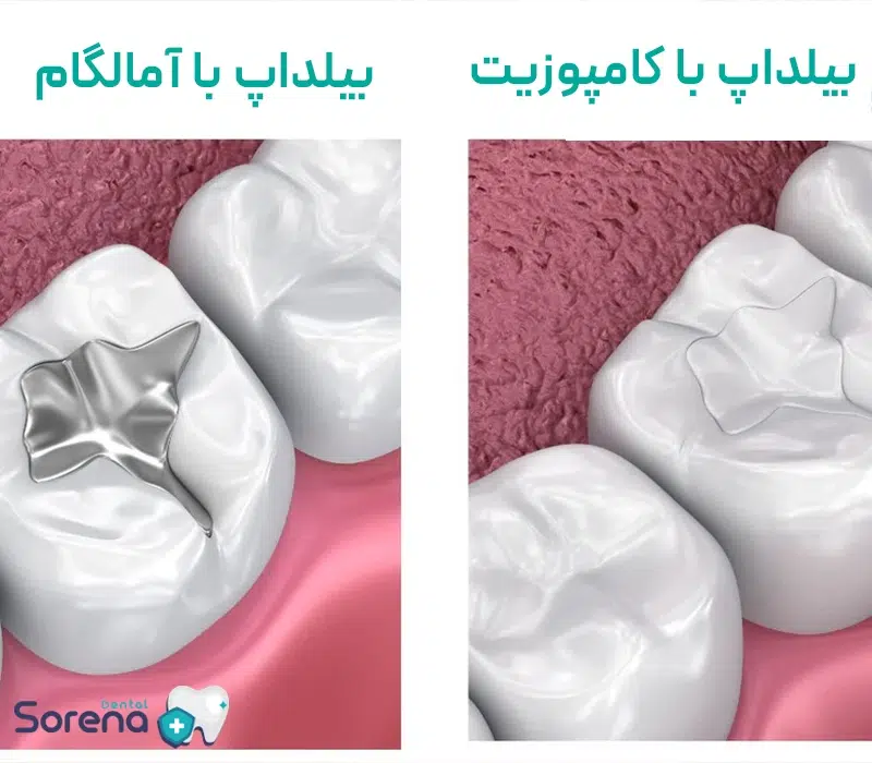 بیلداپ دندان با امالگام و کامپوزیت