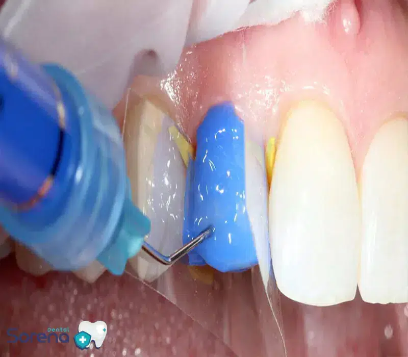 کاربرد اسید اچ در دندانپزشکی