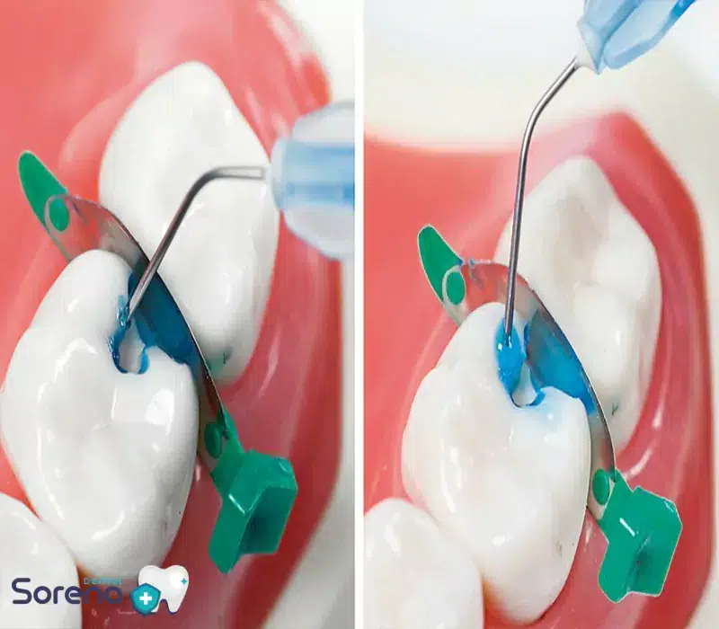 عوارض اسید اچ در دندانپزشکی