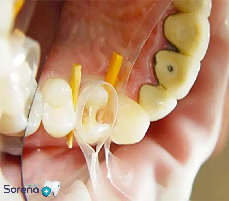 ضرورت استفاده از وج دندانپزشکی