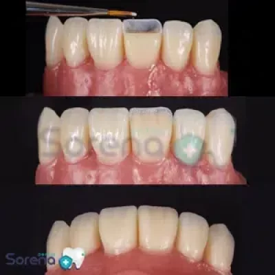 لیرینگ دندان چیست؟