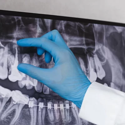 تشخیص پوسیدگی دندان از روی عکس