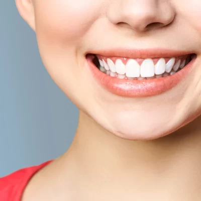 restoration of anterior teeth using an indirect composite technique