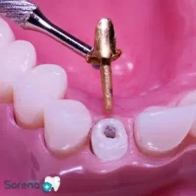 پست دندان چیست