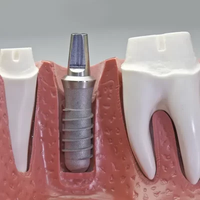 نحوه Fiber post cementing