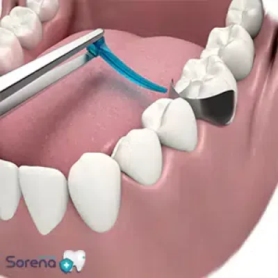وج دندانپزشکی چیست؟